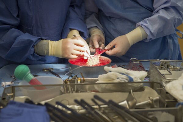 Organ Stransplant Organ Transplant