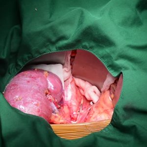 Human Kidney For Sale